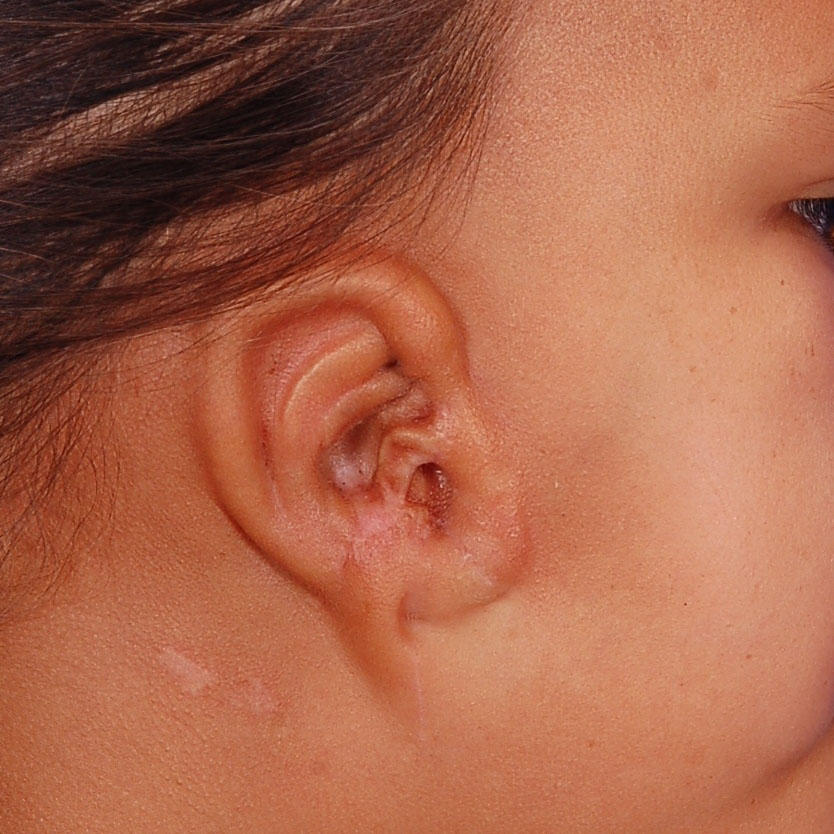 Cirurgia para reconstrução da orelha