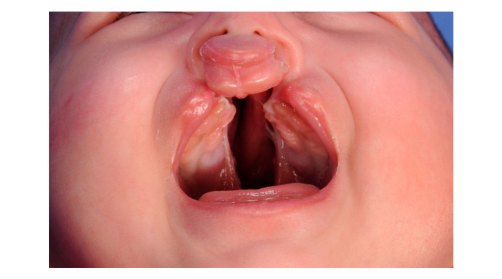 Classificação de Spina – Tipos de fissura labiopalatinas