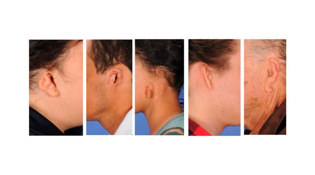 Tipos de malformações na orelha