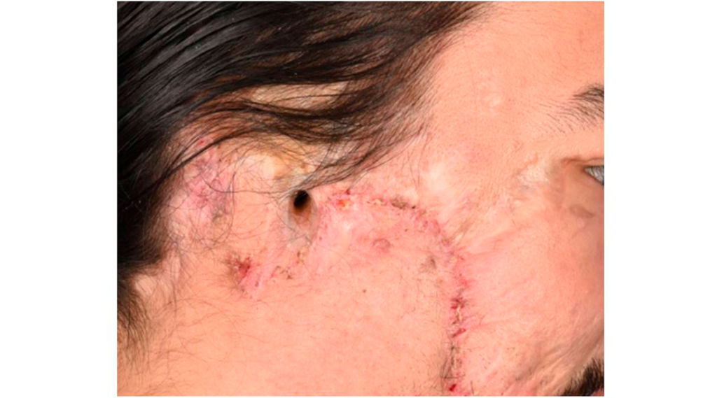 Avulsão de orelha: Você sabe o que é?