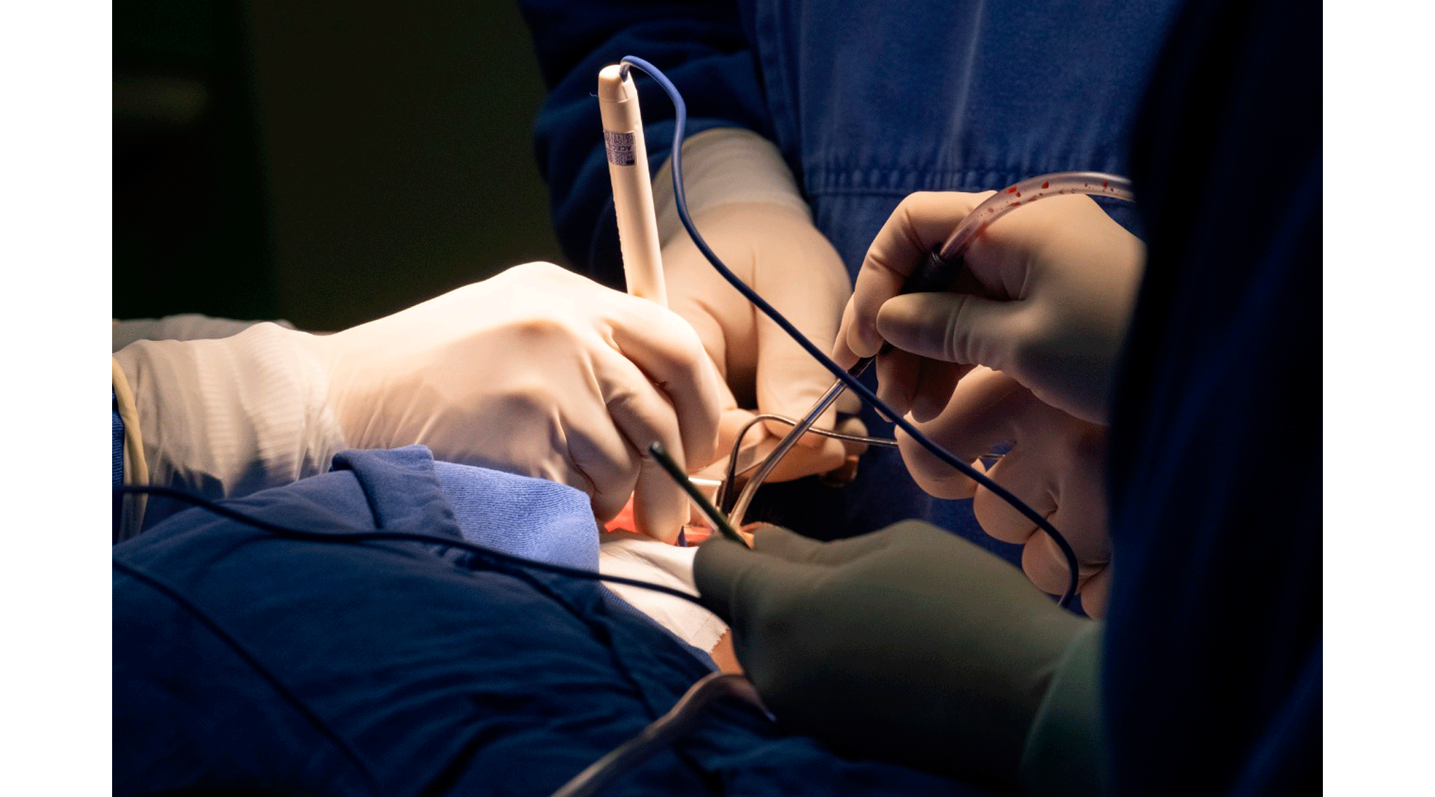 Tudo sobre cirurgia de reconstrução de orelha com cartilagem costal