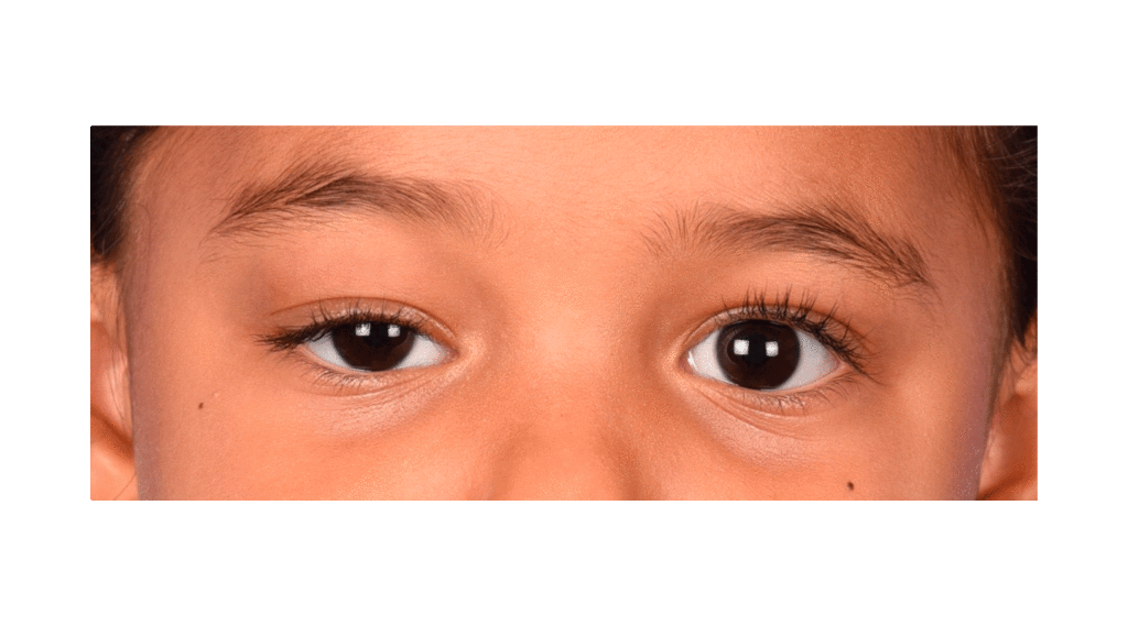 Ptose congênita: saiba o que é e quais são as causas