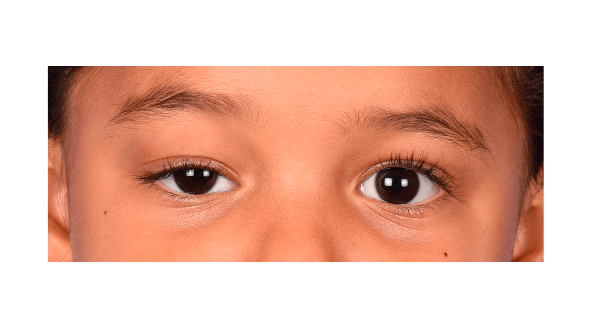 Ptose congênita: saiba o que é e quais são as causas