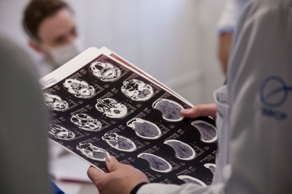 Dúvidas comuns após a cirurgia de cranioestenose