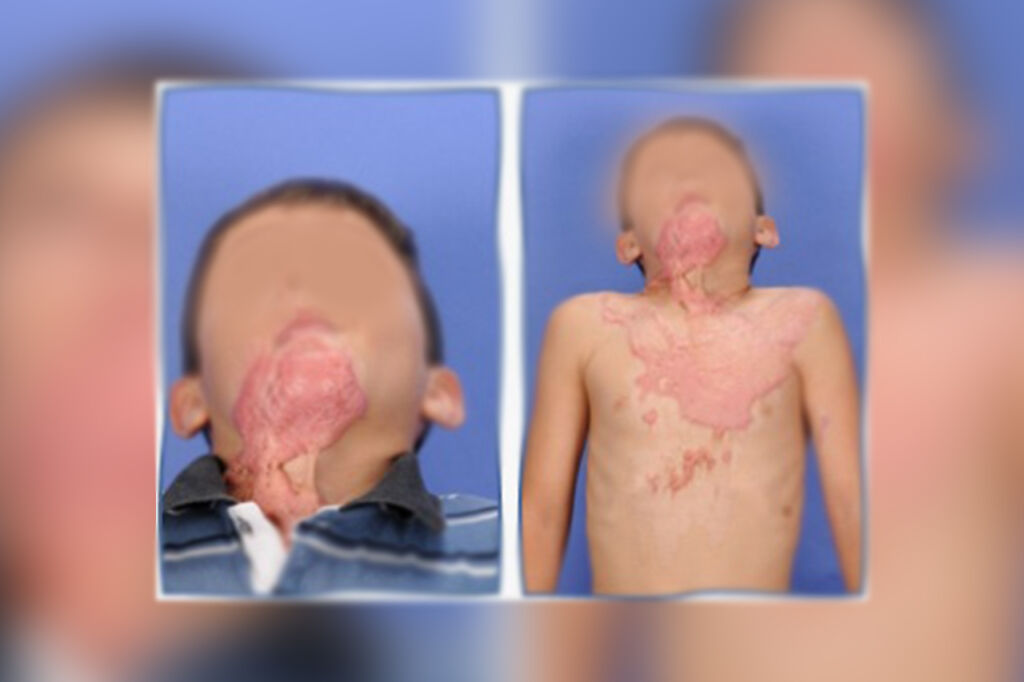 Dia Nacional de Luta contra Queimaduras