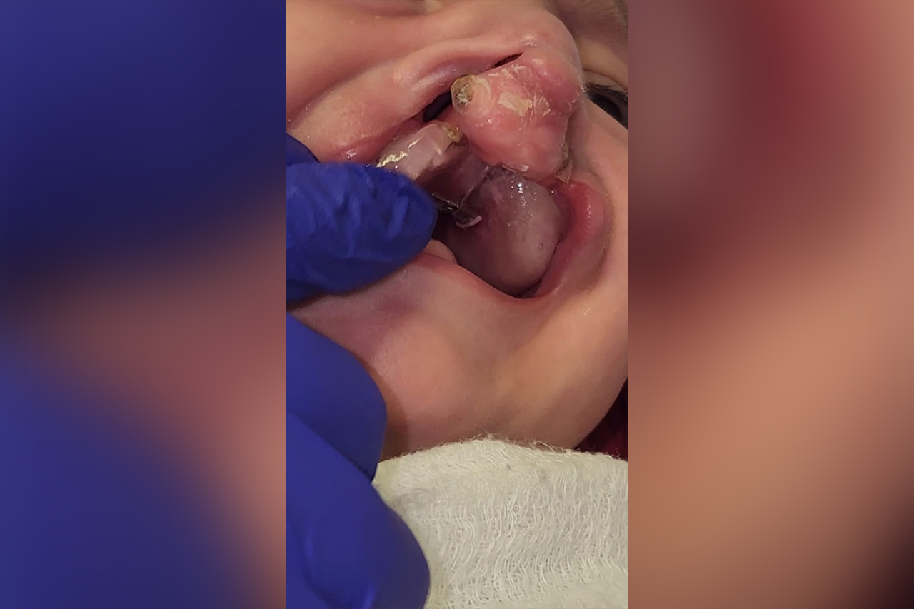 O que fazer para gengiva dos bebês com fissura bilateral ficar na mesma altura que o lábio